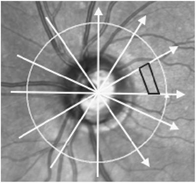 Methods for Quantifying Optic Disc Volume and Peripapillary Deflection Volume Using Radial Optical Coherence Tomography Scans and Association With Intracranial Pressure